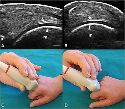 Artificial Intelligence for Ultrasound Informative Image Selection of Metacarpal Head Cartilage. A Pilot Study